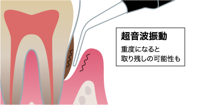 超音波振動によるスケーリング治療