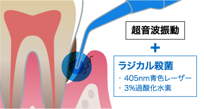 超音波振動 + ラジカル殺菌