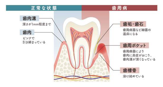 歯周病治療の考え方